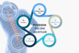 5-soruda-posterior-bulging-nedir